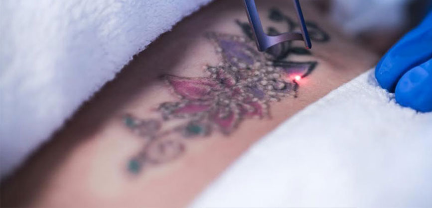 laser tattoo removal